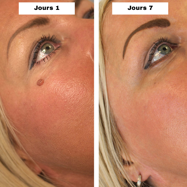 MySkiné™ ¡No más marcas en la piel! ✨