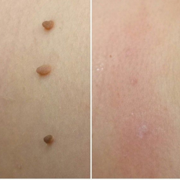 MySkiné™ ¡No más marcas en la piel! ✨