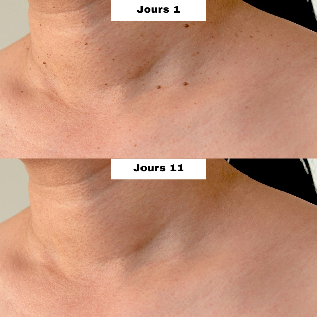 MySkiné™ ¡No más marcas en la piel! ✨